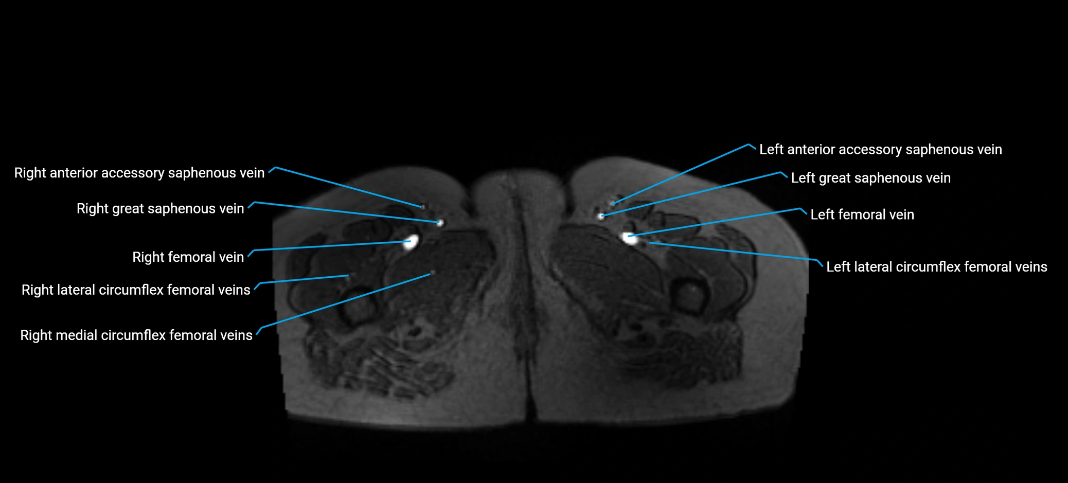 MRV abdomen pelvis & lower limb axial cross sectional anatomy labelled MRI image 208 (1).webp